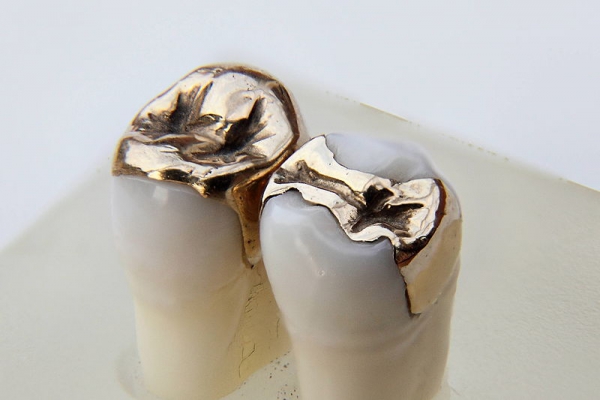 Dental Inlays Gold