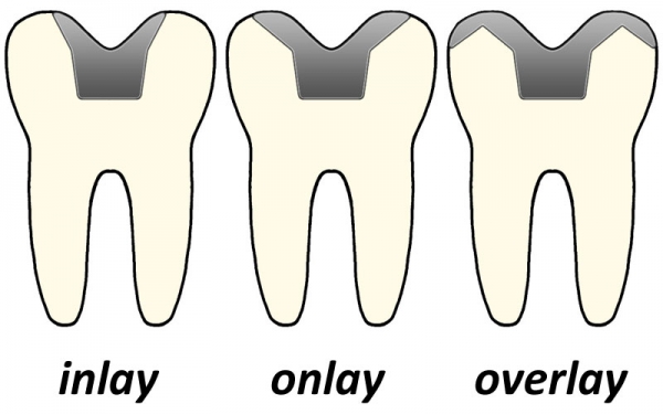 Inlay onlay overlay