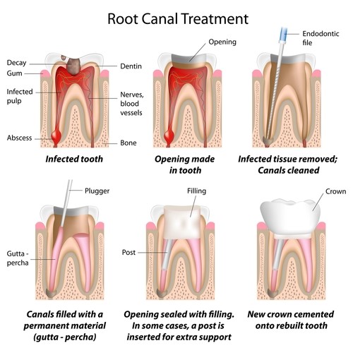 canal treatment