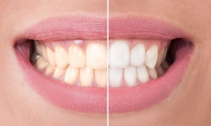 strahlend weiße Zähne dank Bleaching